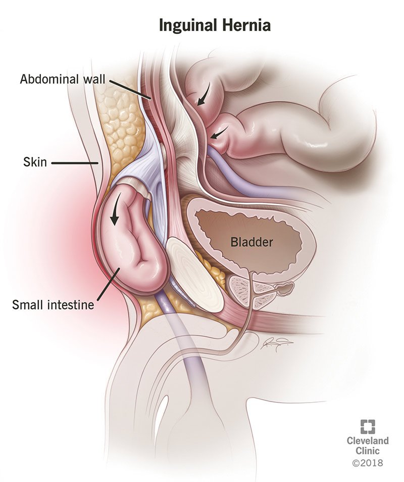 Hernia treatment
