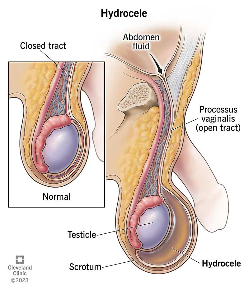 Hydrocele treatment