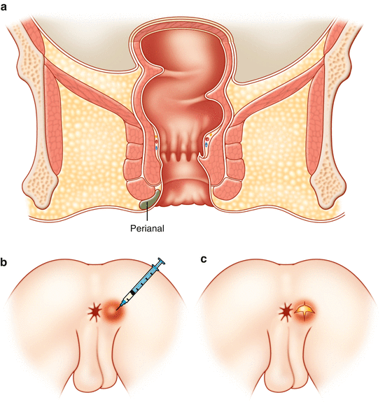 Perianal abscess treatment