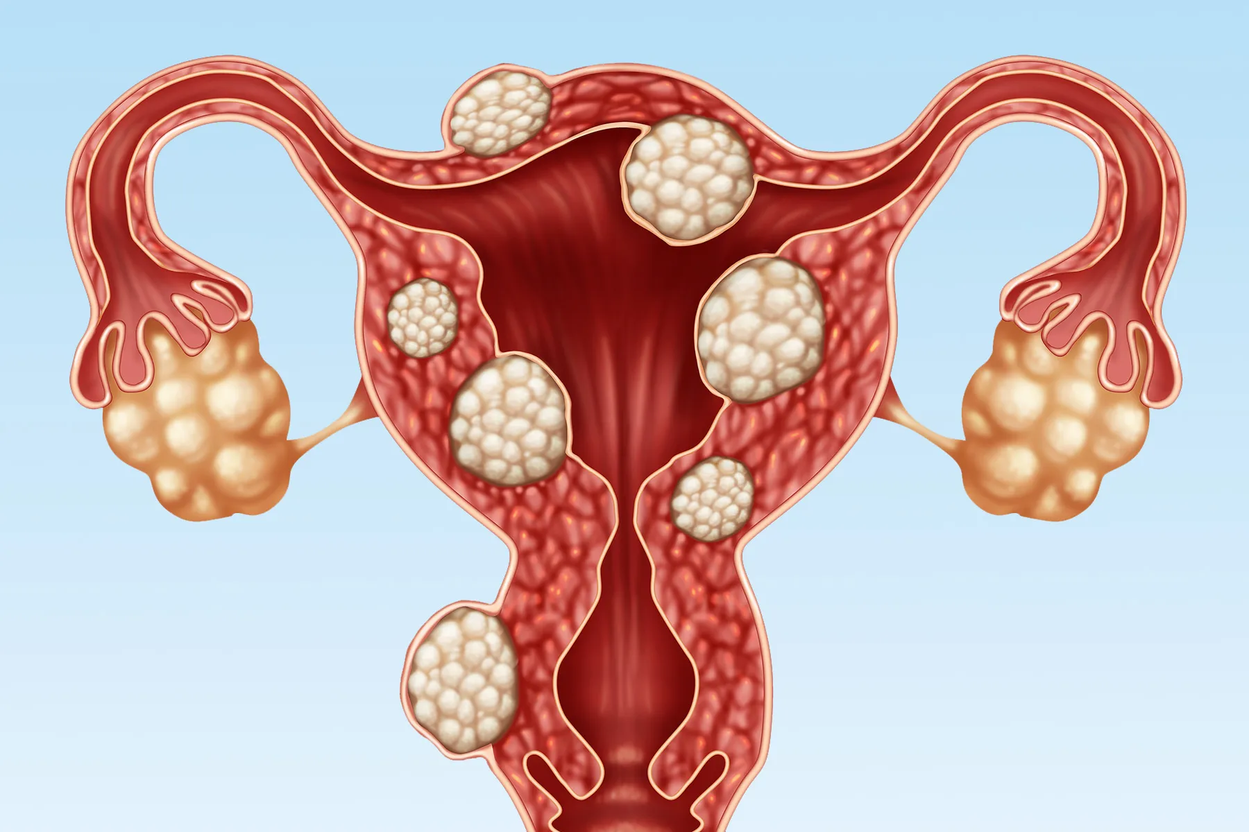 Fibroid treatment