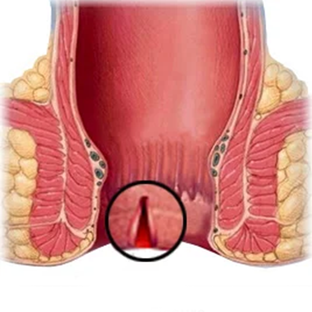 Anal fissure