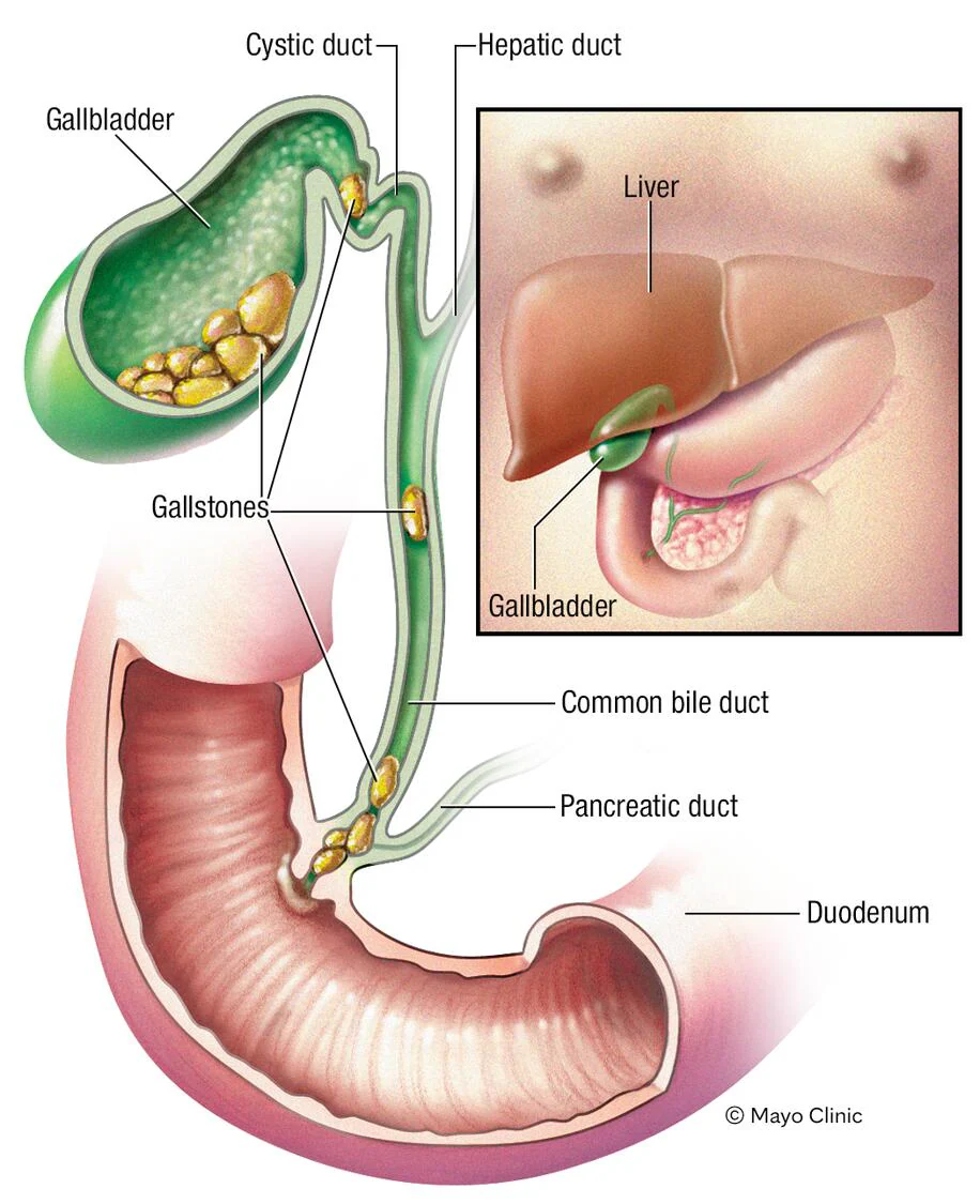 Gallbladder calculus treatment
