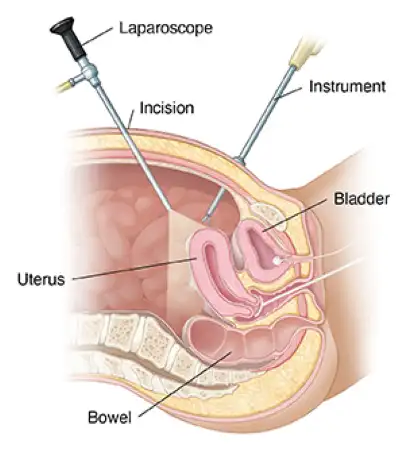 Laparoscopic uterus surgery