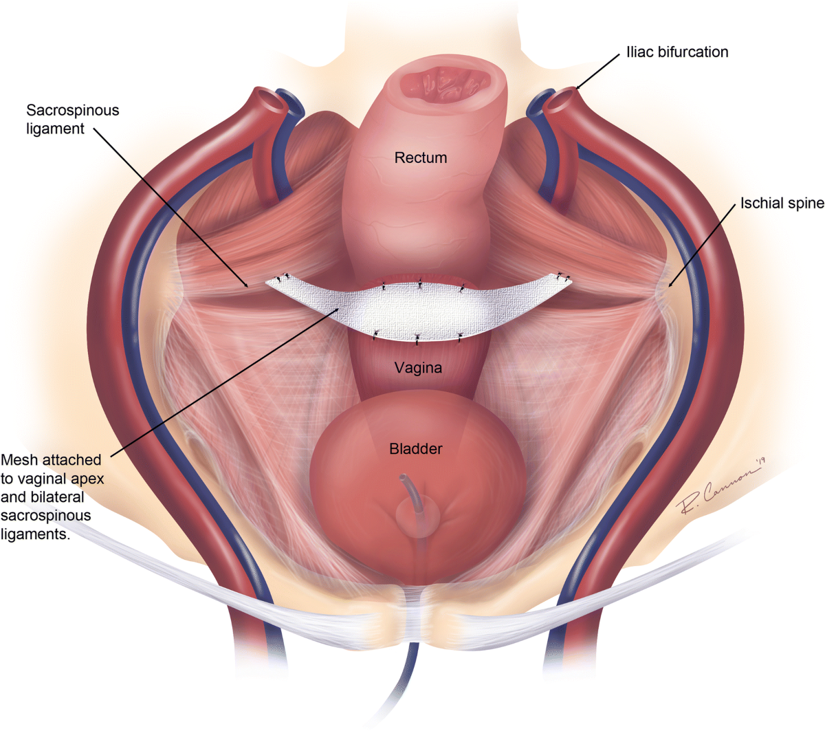 Neuralgia treatment