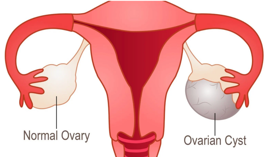 Ovarian cyst treatment