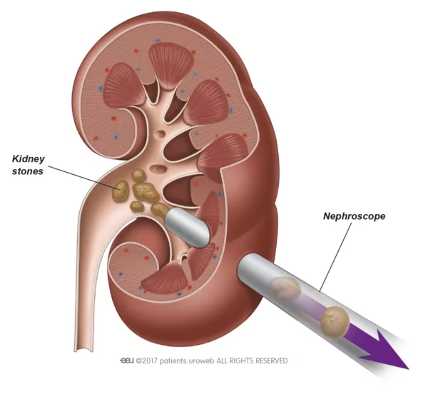 PCNL kidney stone treatment
