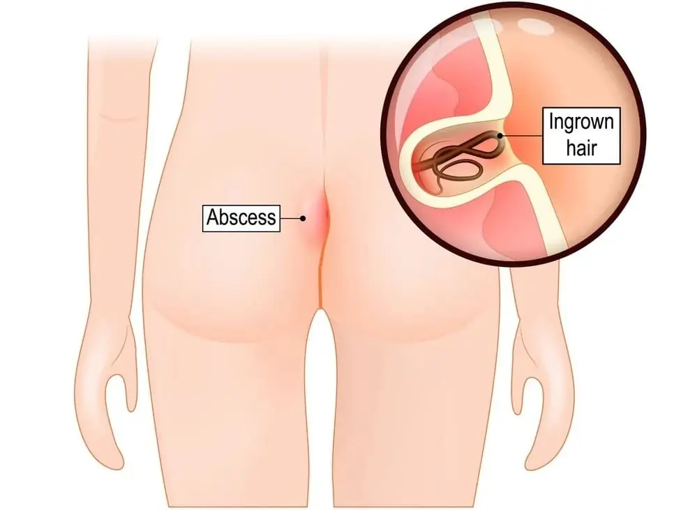 Pilonidal sinus treatment