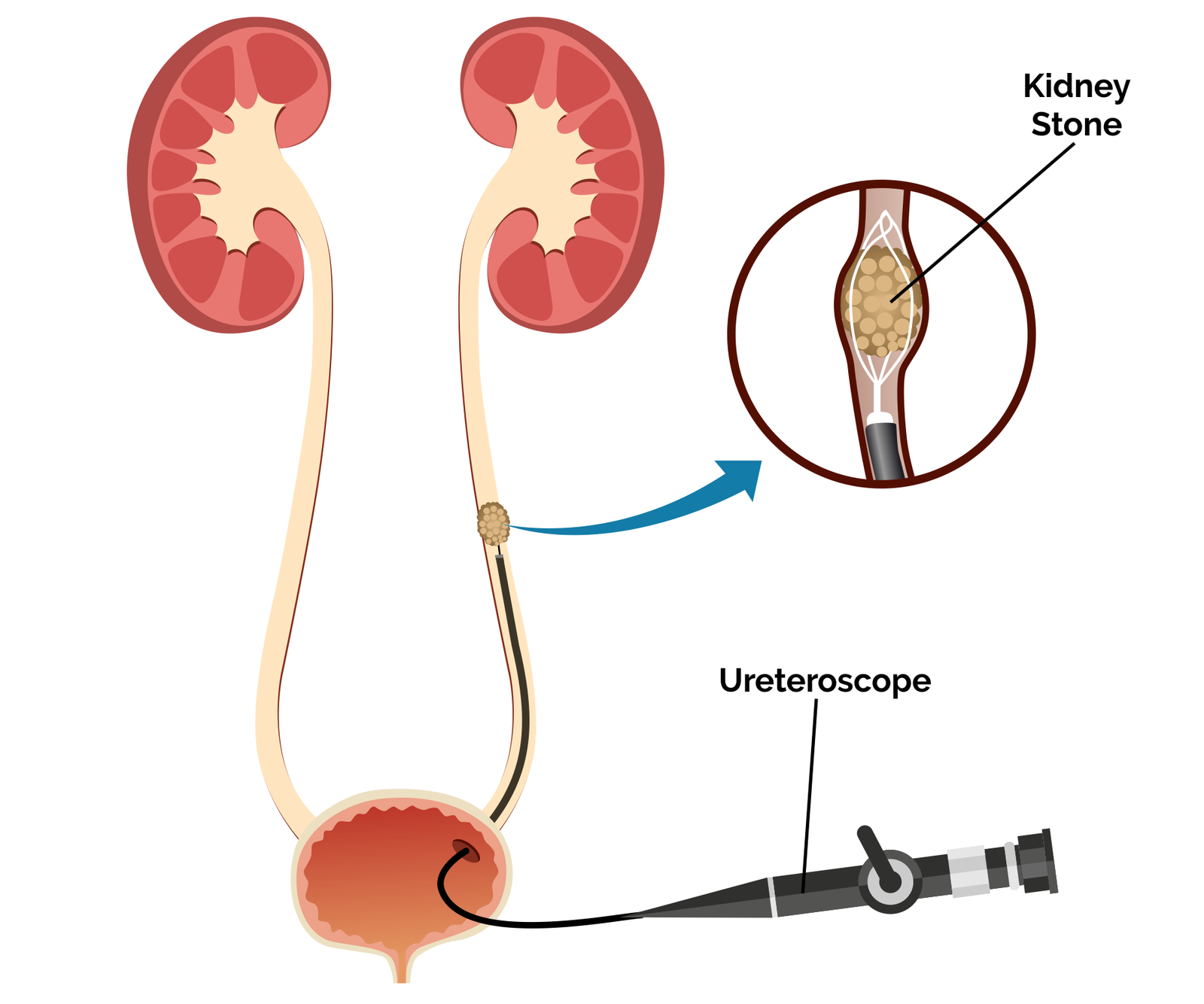 URS ureteric stone treatment