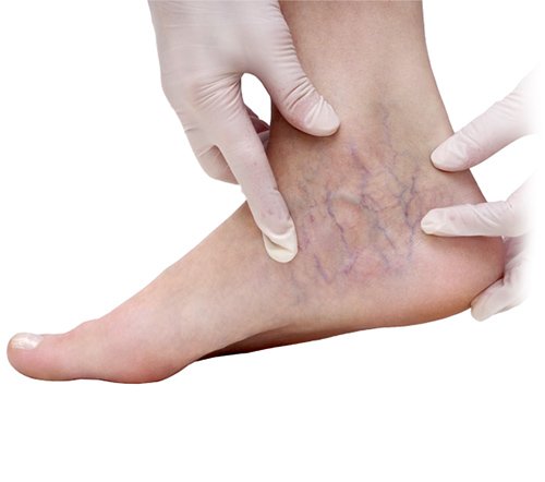 Varicose veins treatment